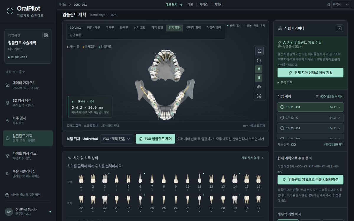 OralPilot — 3D 치아 모델과 임플란트 계획 화면